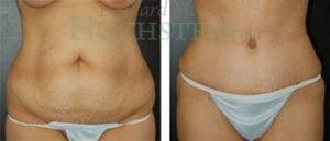 Tummy Tuck Patient 35