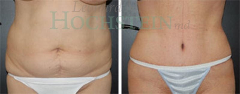 Tummy Tuck Patient
