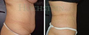 Tummy Tuck Patient