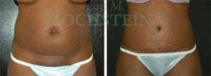 Tummy Tuck Patient