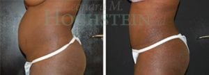 Tummy Tuck Patient
