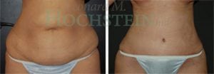 Tummy Tuck Patient
