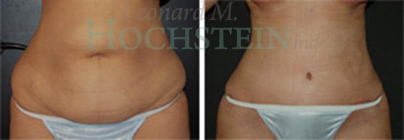 Tummy Tuck Patient