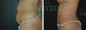 Tummy Tuck Patient