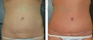 Tummy Tuck Patient