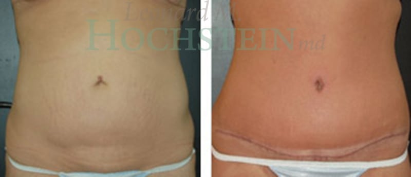 Tummy Tuck Patient