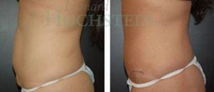 Tummy Tuck Patient
