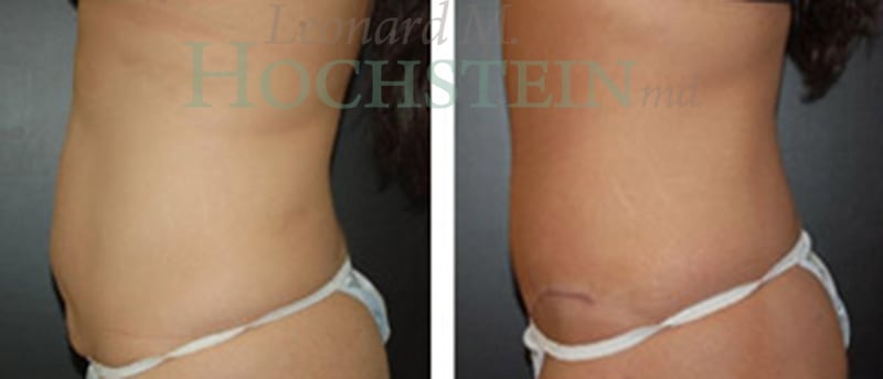 Tummy Tuck Patient