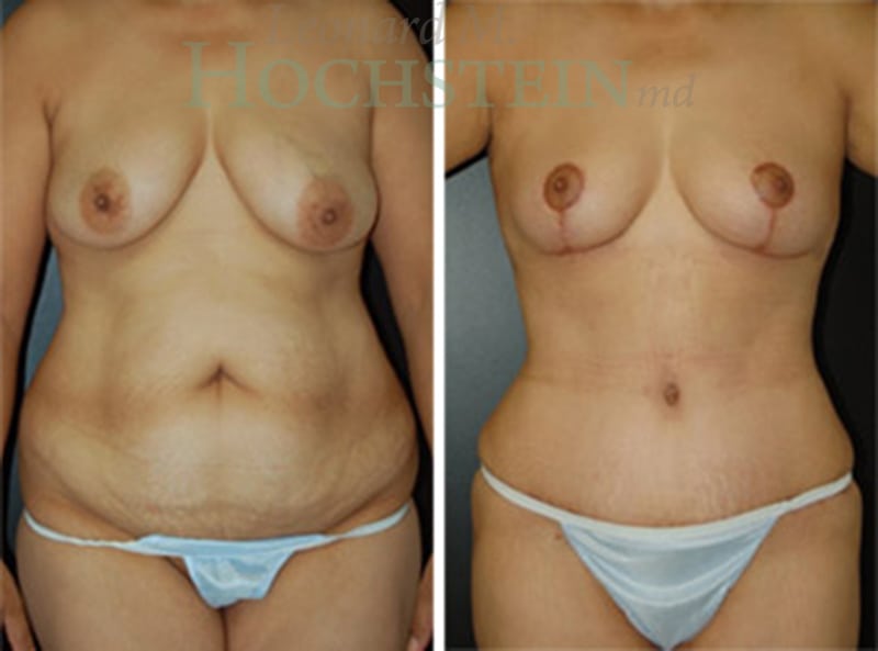 Tummy Tuck Patient