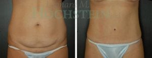 Tummy Tuck Patient