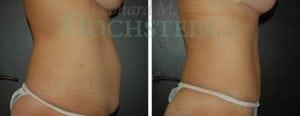 Tummy Tuck Patient