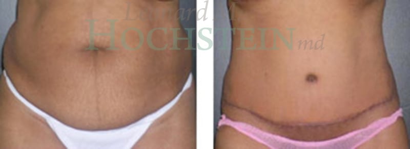 Tummy Tuck Patient