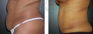 Tummy Tuck Patient