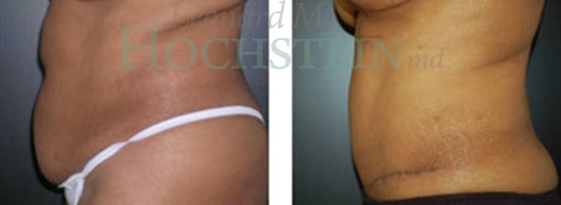 Tummy Tuck Patient