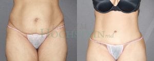 Tummy Tuck Patient