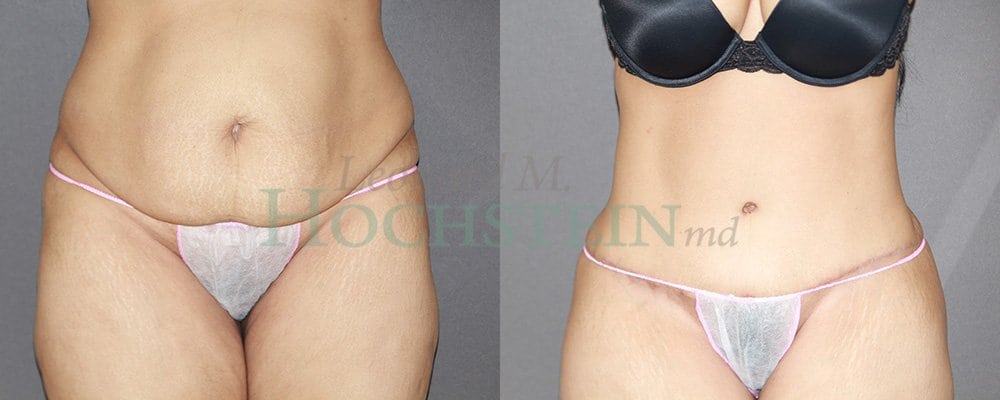 Tummy Tuck Patient
