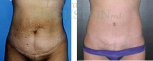 Tummy Tuck Patient 45