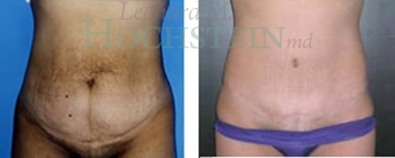 Tummy Tuck Patient