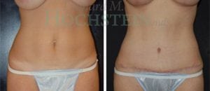 Tummy Tuck Patient 46