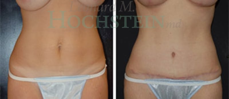Tummy Tuck Patient