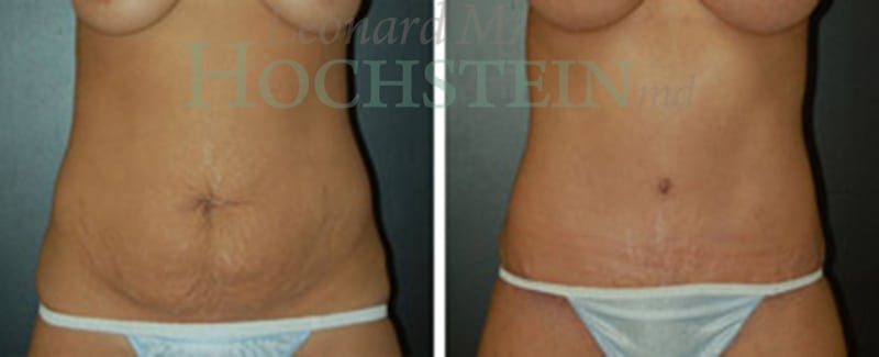 Tummy Tuck Patient