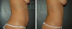 Tummy Tuck Patient