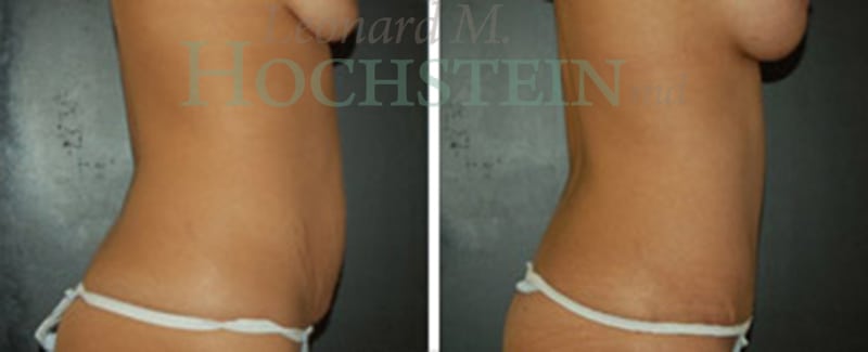 Tummy Tuck Patient