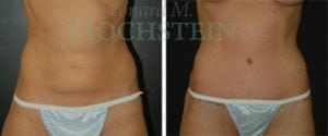 Tummy Tuck Patient