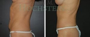 Tummy Tuck Patient