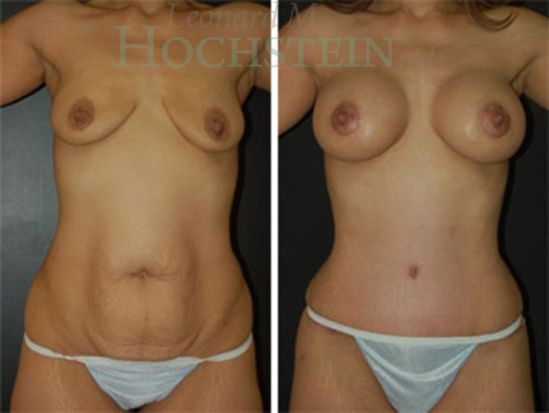 Tummy Tuck Patient