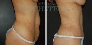 Tummy Tuck Patient