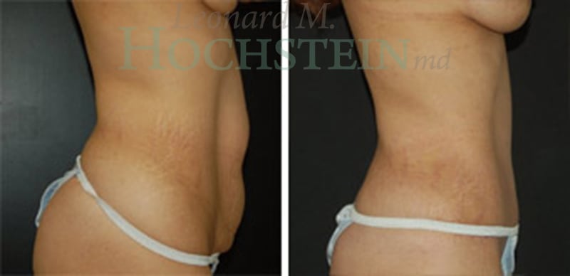 Tummy Tuck Patient