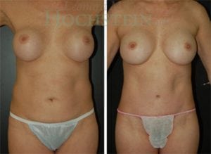 Tummy Tuck Patient