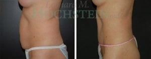 Tummy Tuck Patient