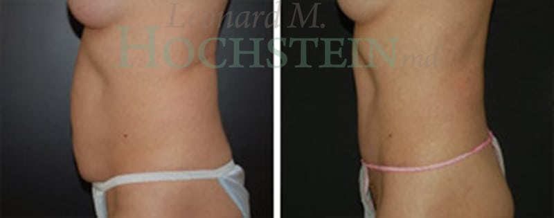 Tummy Tuck Patient