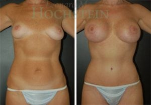 Tummy Tuck Patient 51