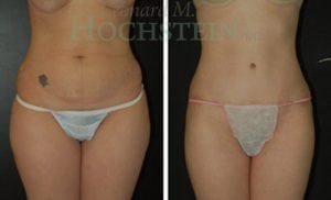 Tummy Tuck Patient