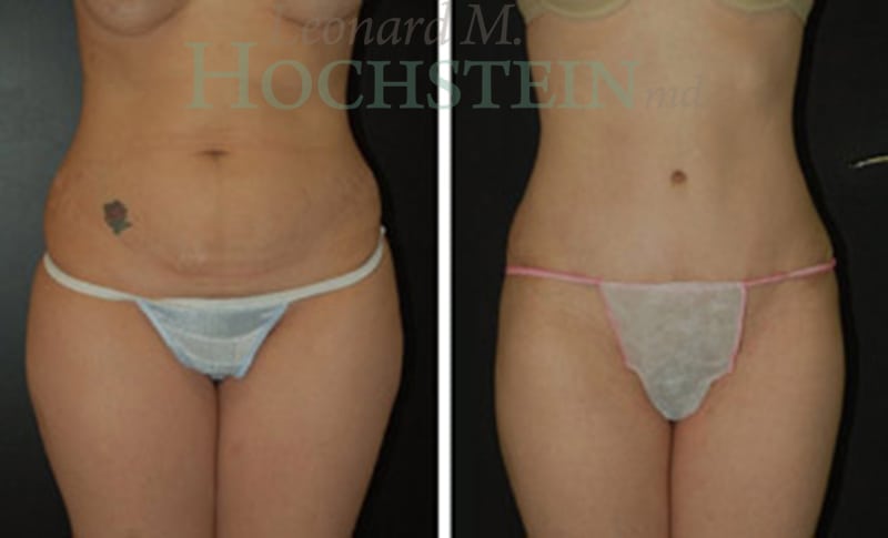 Tummy Tuck Patient