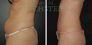 Tummy Tuck Patient