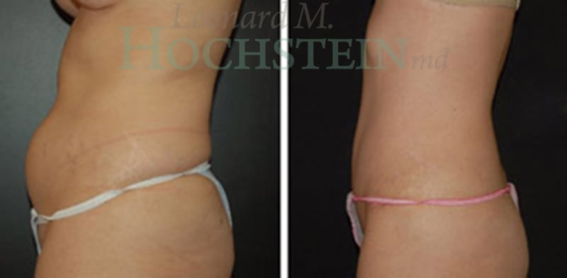 Tummy Tuck Patient