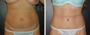 Tummy Tuck Patient