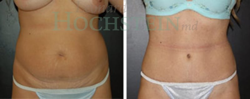 Tummy Tuck Patient