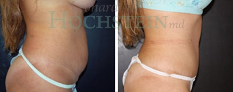 Tummy Tuck Patient