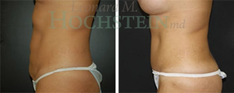 Tummy Tuck Patient