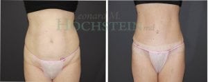 Tummy Tuck Patient