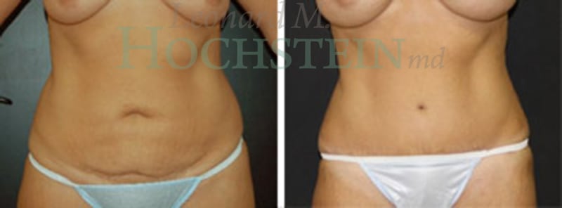 Tummy Tuck Patient