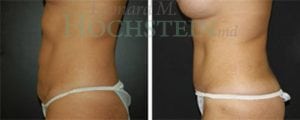 Tummy Tuck Patient
