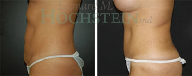 Tummy Tuck Patient