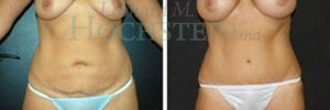 Tummy Tuck Patient
