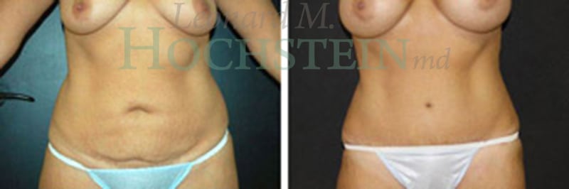 Tummy Tuck Patient